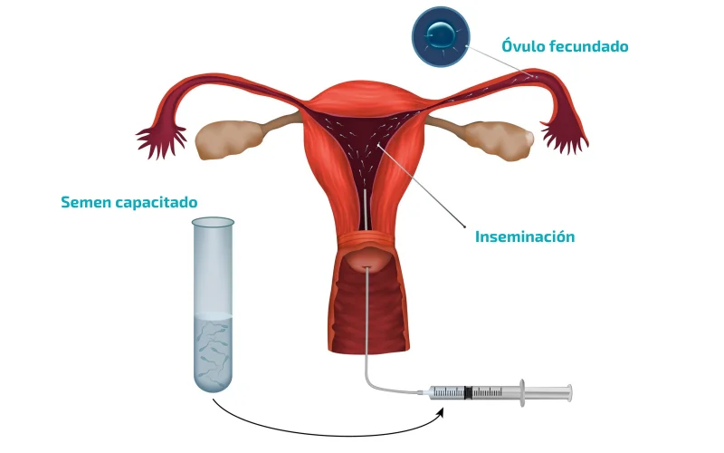 Inseminación artificial